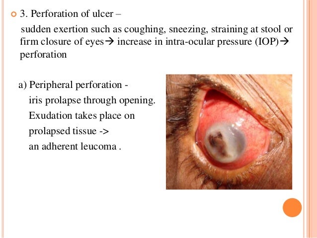 4some extra hot Difference between perforated and penetrate ulcers